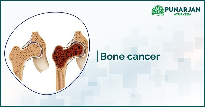 bone cancer