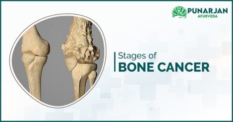Stages-of-Bone-Cancer