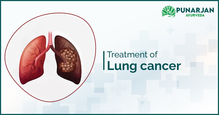 Treatment-of-lung-cancer
