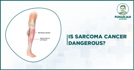 Sarcoma_Cancer_Treatment