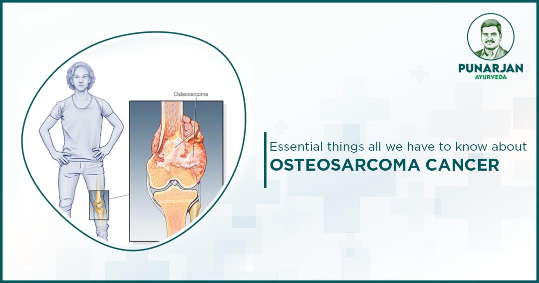 Essential things all we have to know about osteosarcoma Cancer