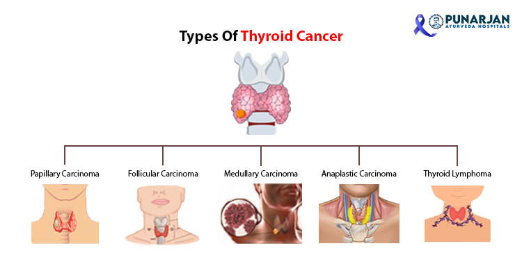 Types Of Thyroid Cancer