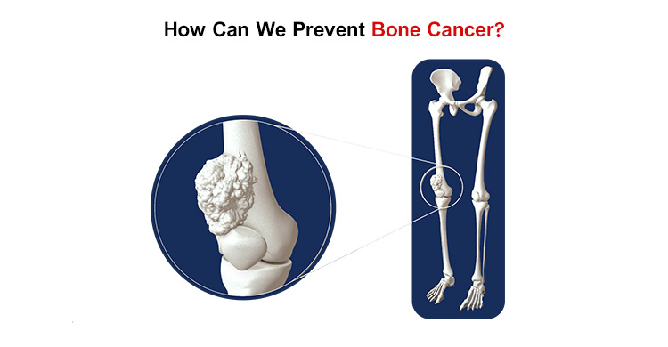 Prevent Bone Cancer