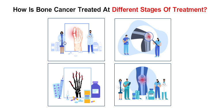 Bone Cancer Treated At Different Stages Of Treatment