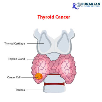 Thyriod Cancer