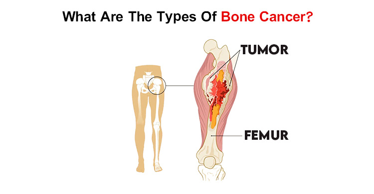 Bone Cancer types