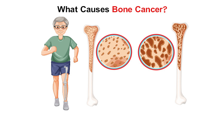 What Causes Bone Cancer