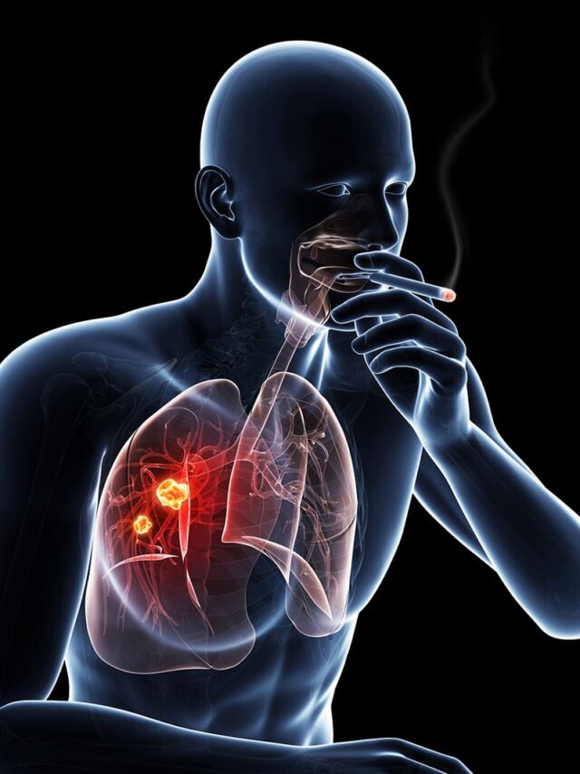 Lung Cancer Basics